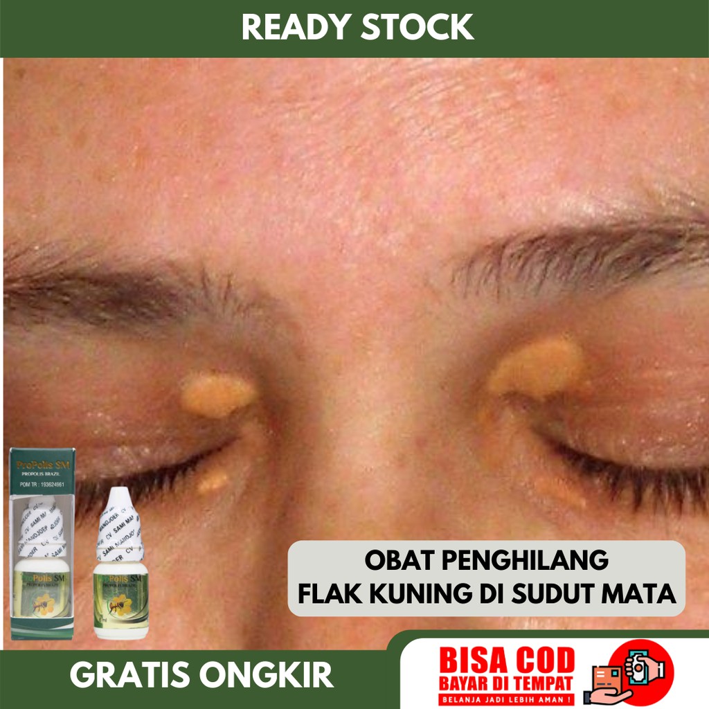 Jual Obat Xanthelasma, Gumpalan Lemak Di Kelopak Mata, Flak Kuning Di ...