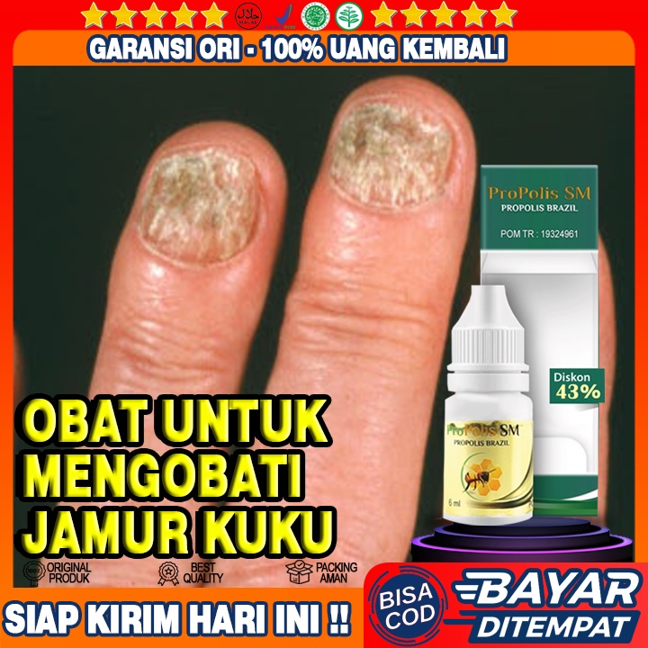 Jual Obat Untuk Mengobati Jamur Kuku Jamur Kuku Pitting Kuku