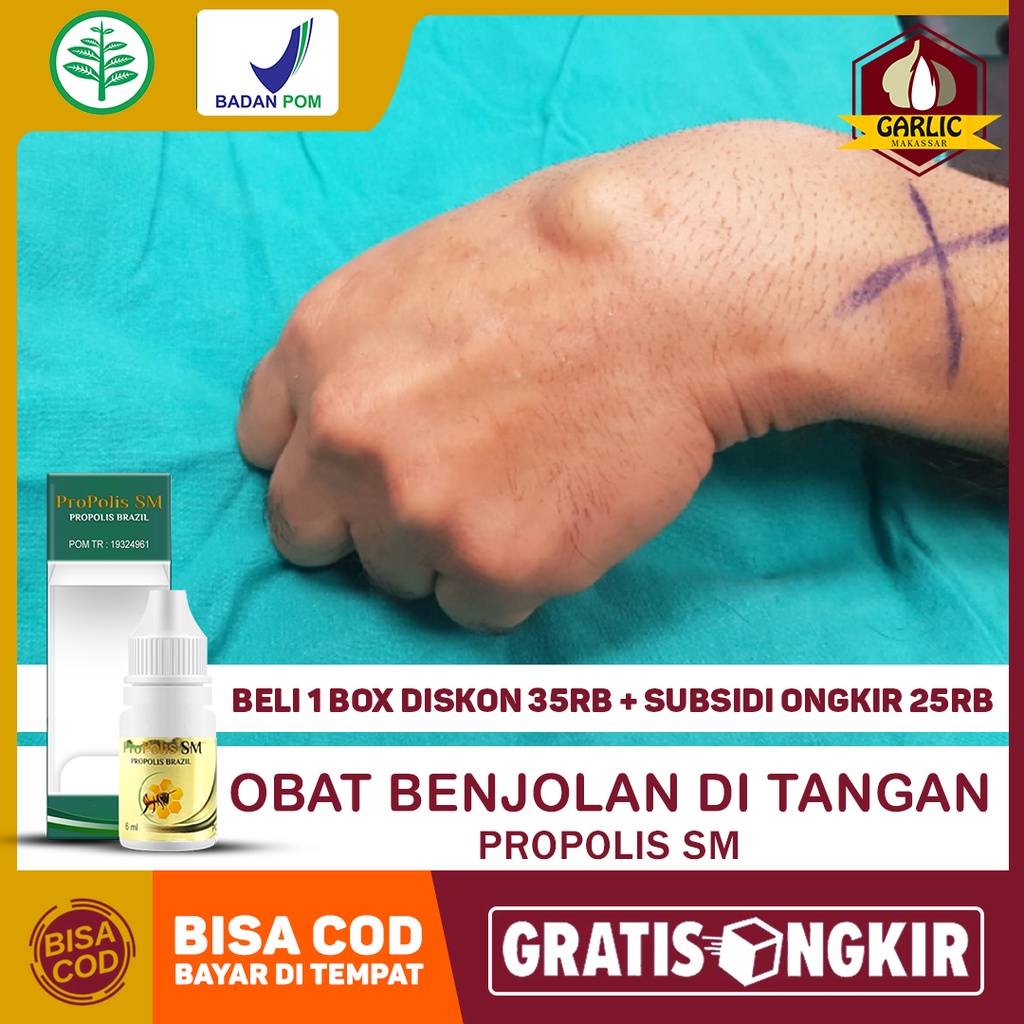 Jual Obat Benjolan Di Tangan, Pergelangan Tangan, Kista Ganglion, Uci ...