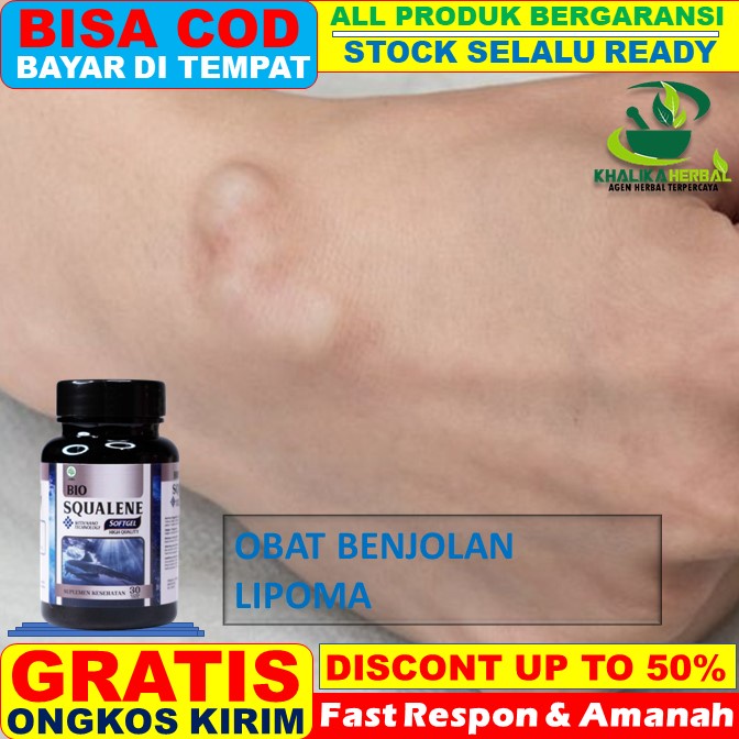 Jual Obat Benjolan Lemak (Lipoma) Benjolan Di Tangan, Benjolan Di Perut ...