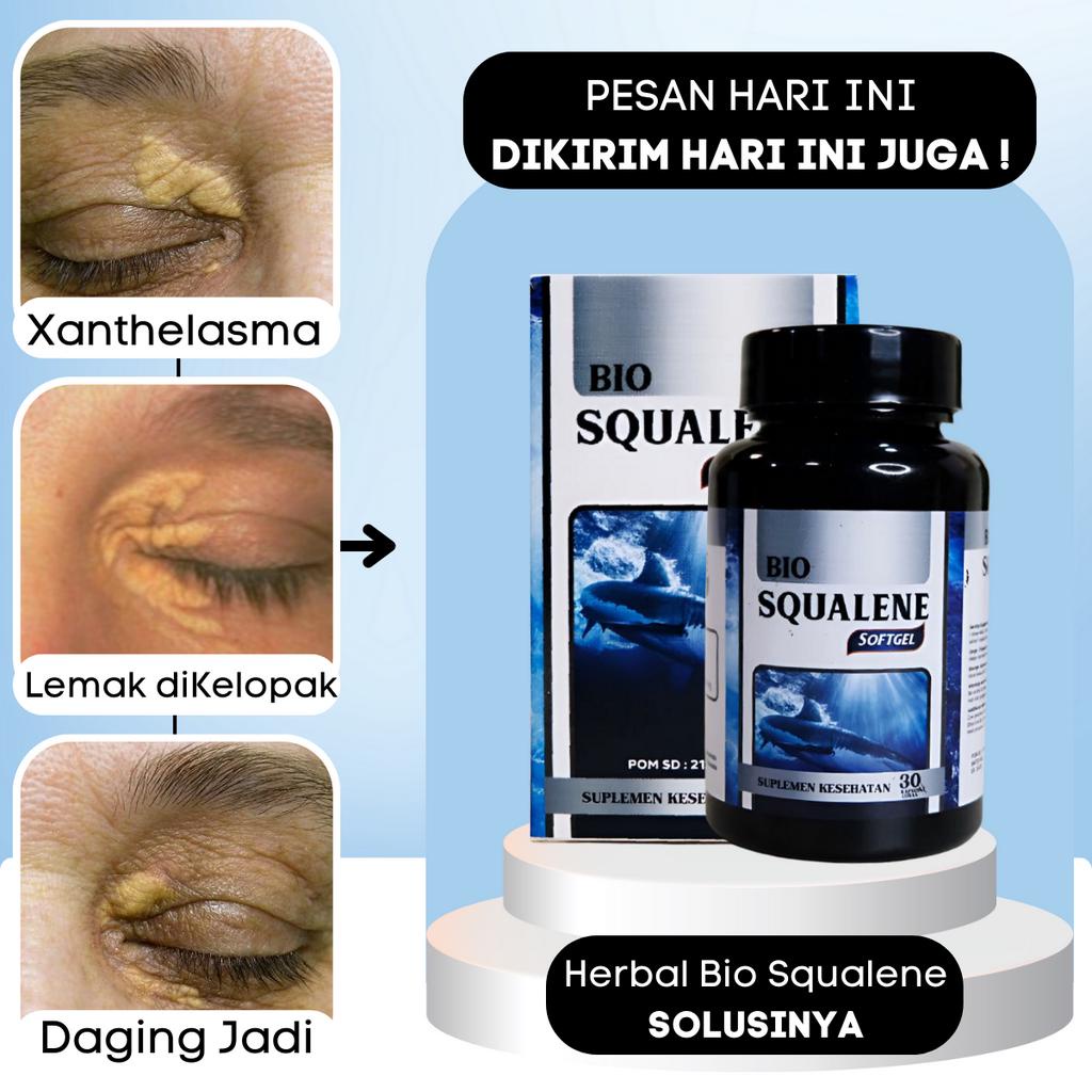 Jual Obat Xanthelasma Gumpalan Lemak Di Kelopak Mata - Obat Penghilang ...