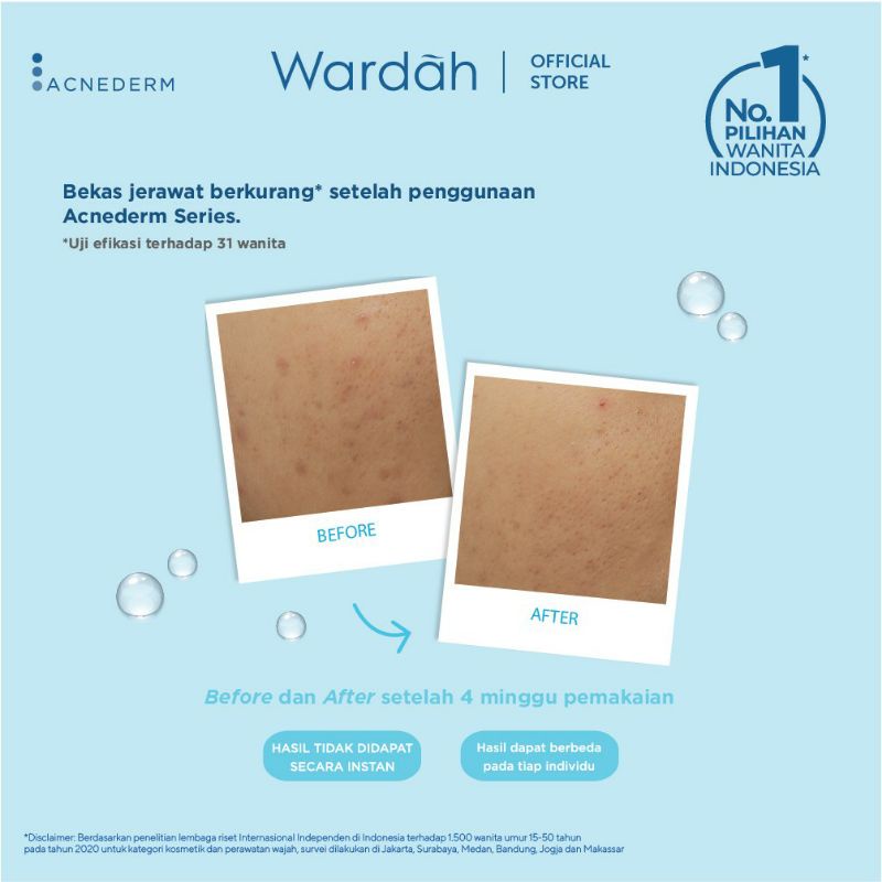 Jual Wardah Acnederm Acne Spot Treatment Gel (15ml) | Shopee Indonesia