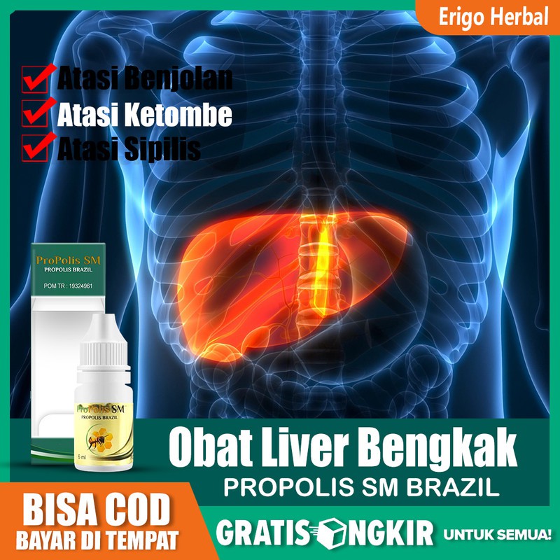 Jual Obat Liver Bengkak Perut, Sirosis, Hepatitis A B C Herbal Asli ...