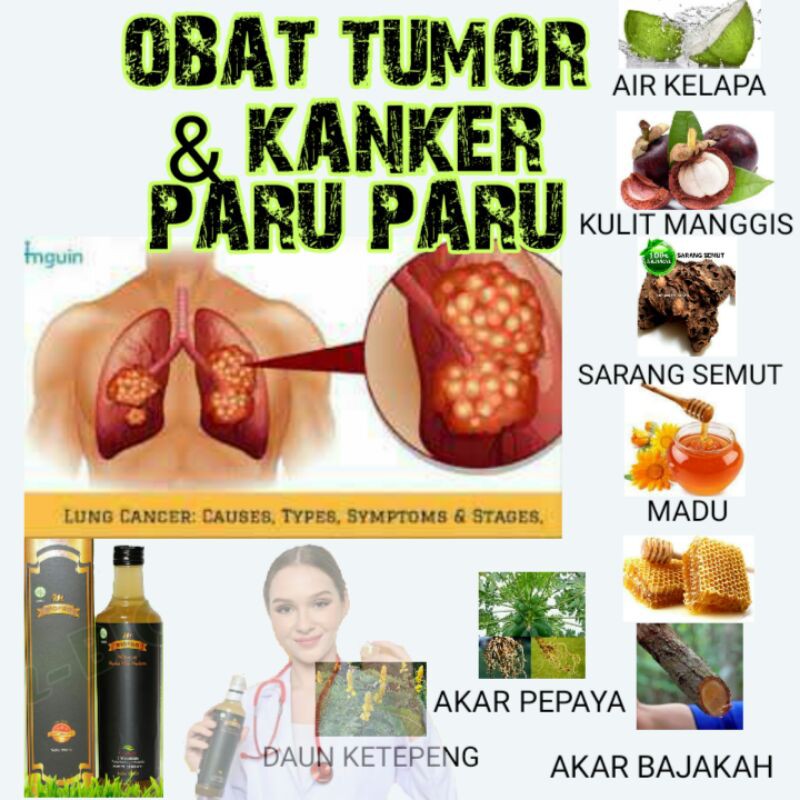 Cara Mencegah Kanker Paru-paru Sel Kecil dan Cara Mengobatinya