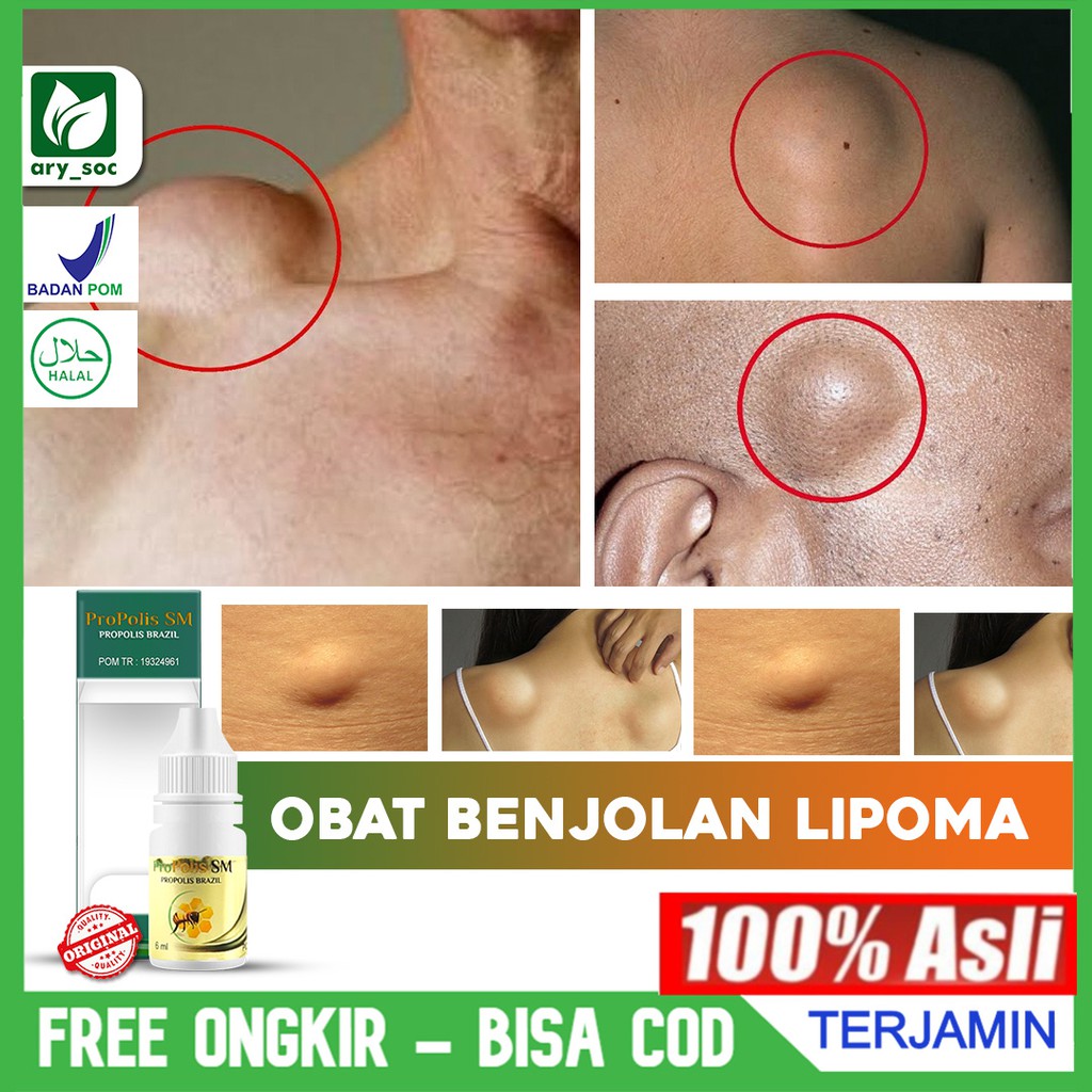 Jual Obat Benjolan Lipoma - Benjolan Lemak - Benjolan Abnormal ...