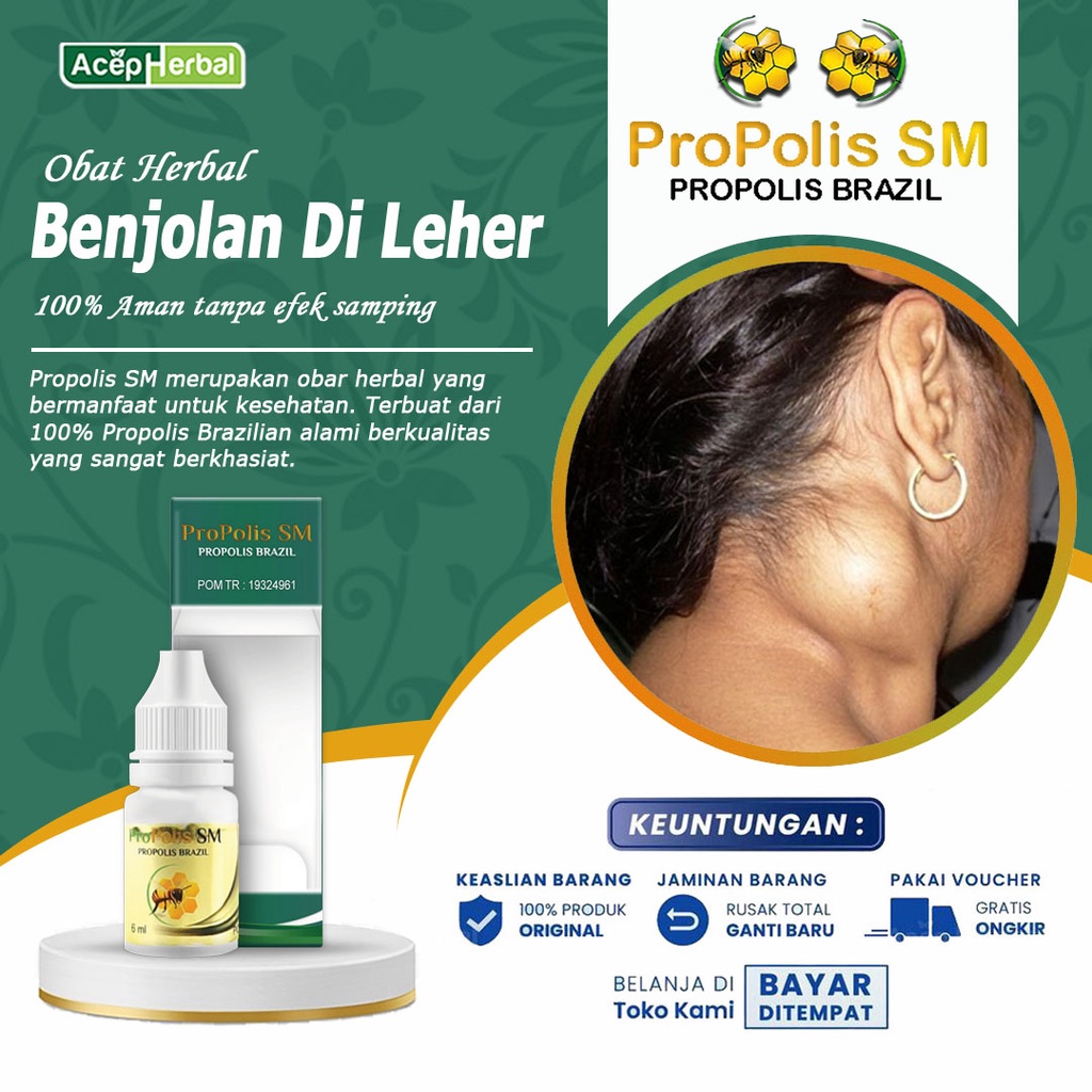 Jual Obat Benjolan Di Leher Penghancur Benjolan Di Leher Kelenjar Getah ...