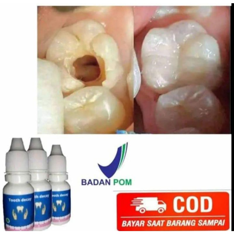 Jual TOOTH DECAY (PENUMBUH GIGI, OMPONG, KEROPOS, BERLUBANG, PATAH