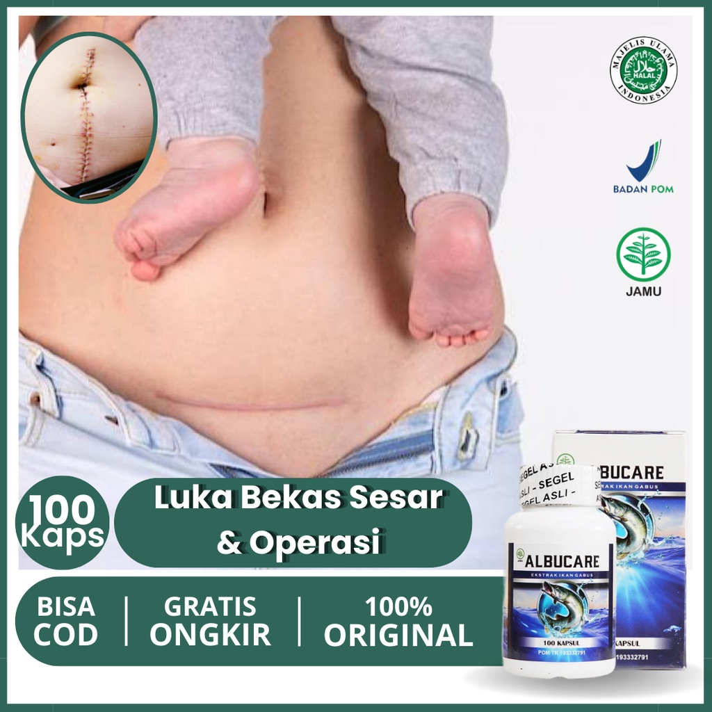 Jual Obat Mengeringkan Luka Bekas Caesar Penghilang Luka Bekas Operasi ...