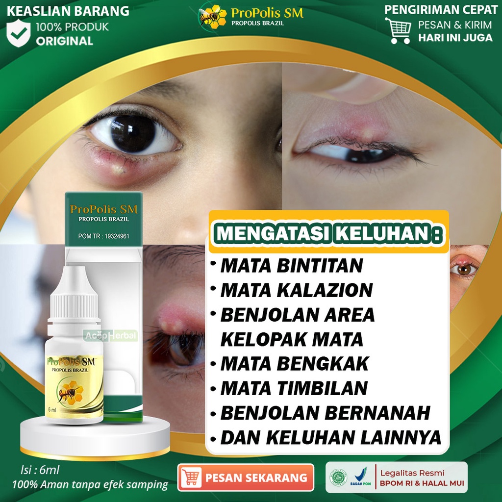 Jual Obat Mata Bintitan Timbilan Kalazion Di Kelopak Mata Benjolan Bernanah Mata Bengkak