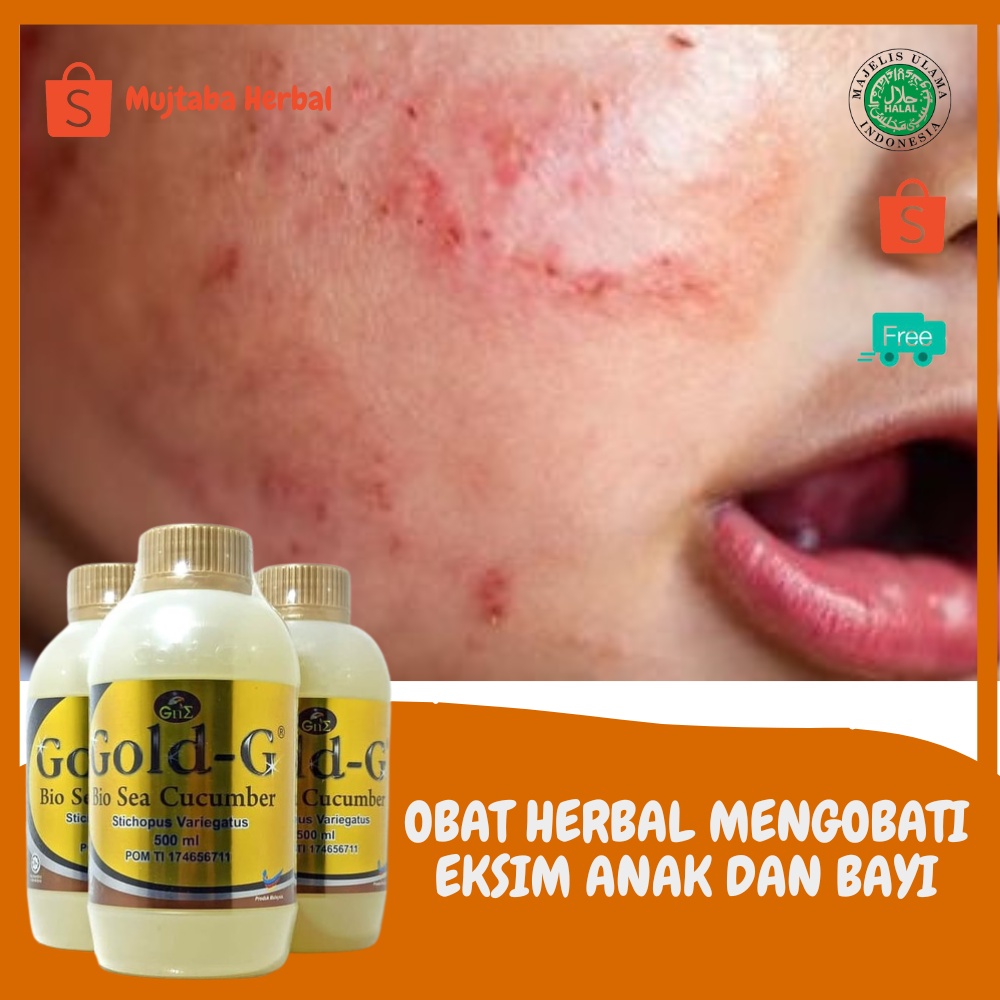 Jual GOLD-G Obat Herbal Gatal Ruam Eksim Untuk Anak Dan Bayi,Kulit ...