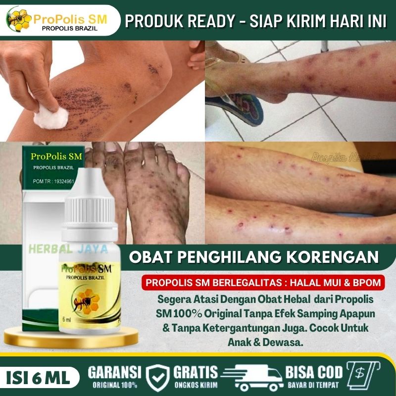 Jual Salep Penghilang Bekas Koreng Obat Korengan Bernanah Obat Bekas