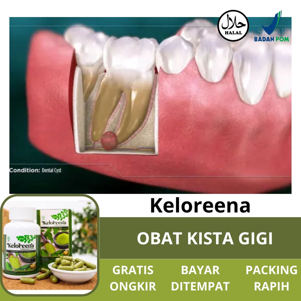 Jual Obat Kista Gigi - Penghancur Kista Benjolan Berisi Cairan Pada ...