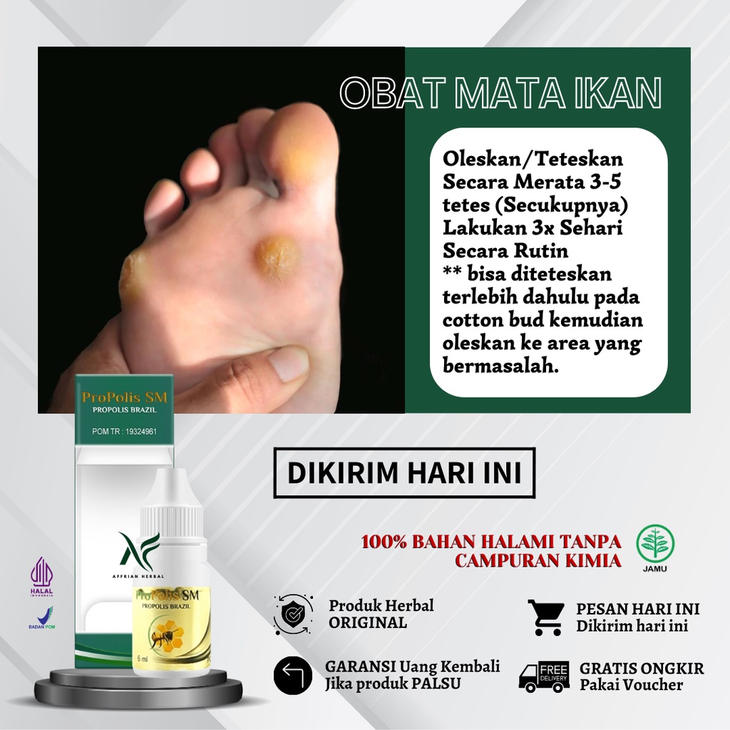 Jual Obat Mata Ikan Telapak Kaki - Obat Mata Ikan Di Telapak Kaki