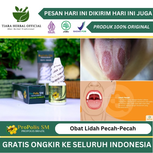 Jual Obat Lidah Pecah Pecah Obat Kandidiasis Mukokutan Obat Lidah Putih Berjamur Infeksi 1040