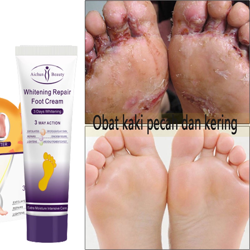 Jual Obat Kaki Pecah Dan Kering Foot Cream Tumitku Obat Kaki Pecah 30g