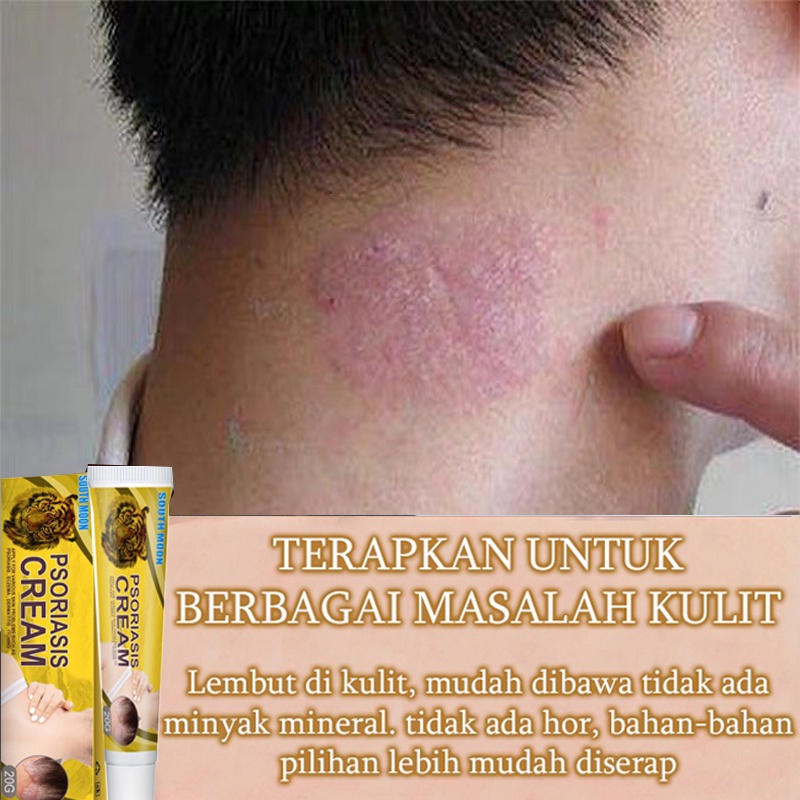 Jual Salep Gatal Obat Gatal Kulit 20g Kulit Kepala Psoriasis Tangan