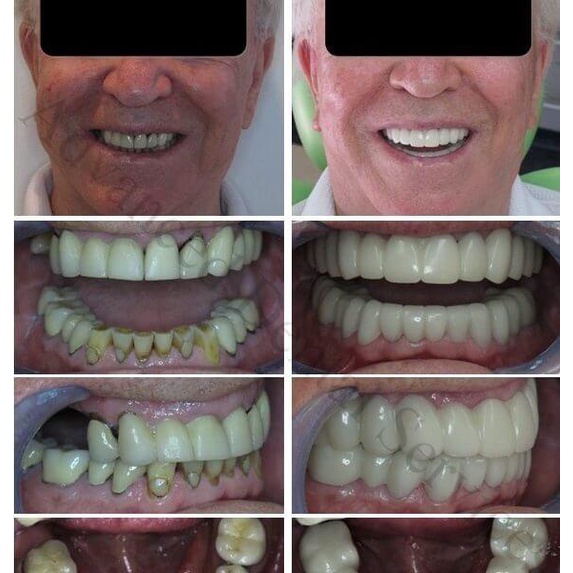 Jual Snapon Smile Denture Elastic Removable Veneer Teeth Gigi Palsu