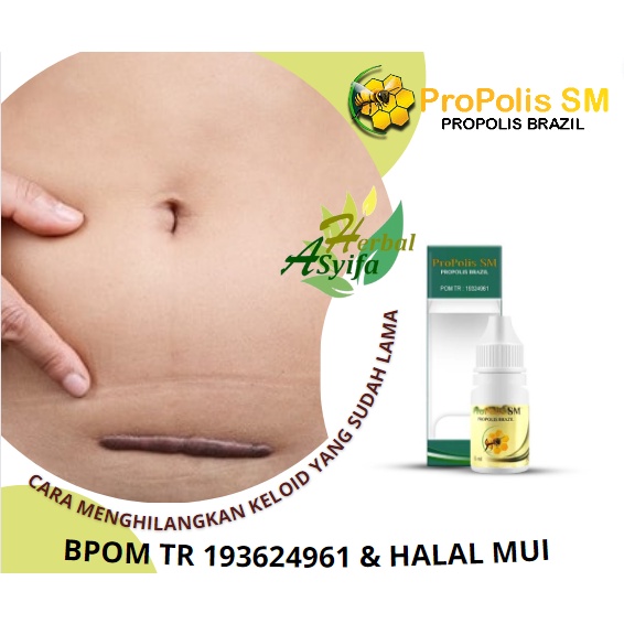 Jual obat untuk menghilangkan keloid yang sudah lama, cara