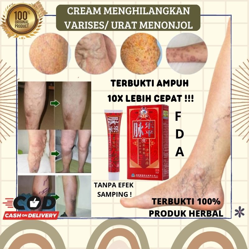 Jual Obat Varises Kaki Ampuh Obat Varises Kaki Krim Medis Pengobatan