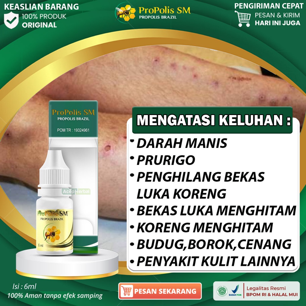 Jual Obat Darah Manis Gatal Prurigo Pembersih Darah Manis Penghilang