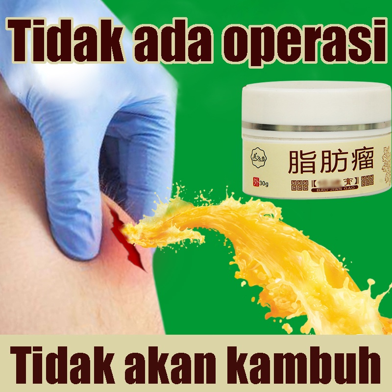 Jual Obat Gondok Hipertiroid Obat Benjolan Kelenjar Getah Bening Minyak Oles Kelenjar Getah