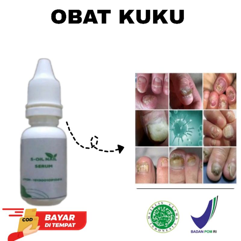 Jual Obat Tetes Penumbuh Kuku Cantengan Jamur Shopee Indonesia