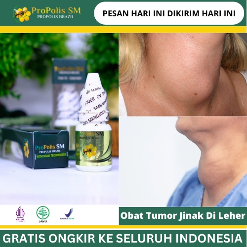 Jual Obat Tumor Jinak Di Leher, Obat Kelenjar Tiroid, Obat Kelenjar ...