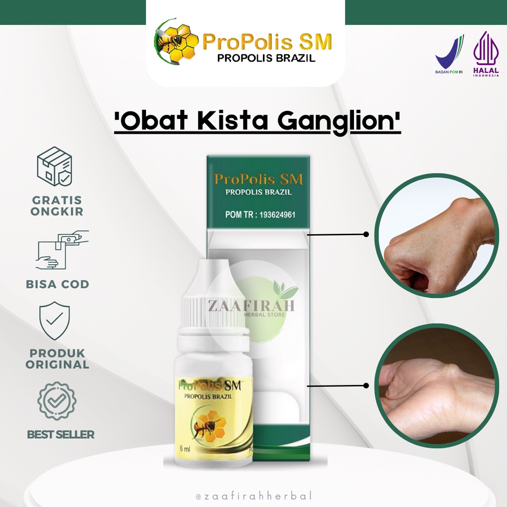 Jual Obat Kista Ganglion Benjolan Di Tangan Benjolan Ganglion Tonjolan ...