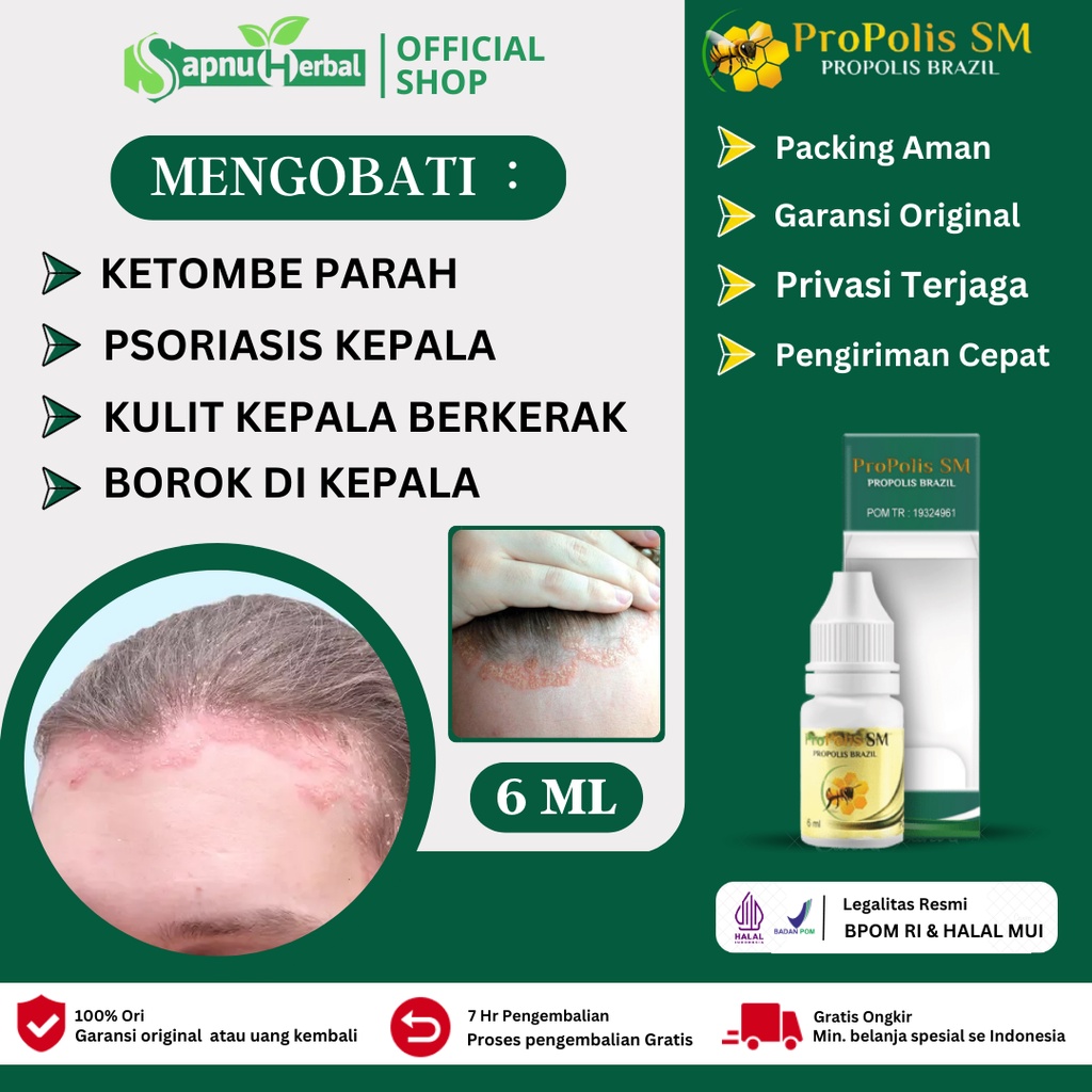 Jual Obat Ketombe Parah Kulit Kepala Kering Bersisik Ketombe Berkerak Ketombe Basah Psoriasis 2621