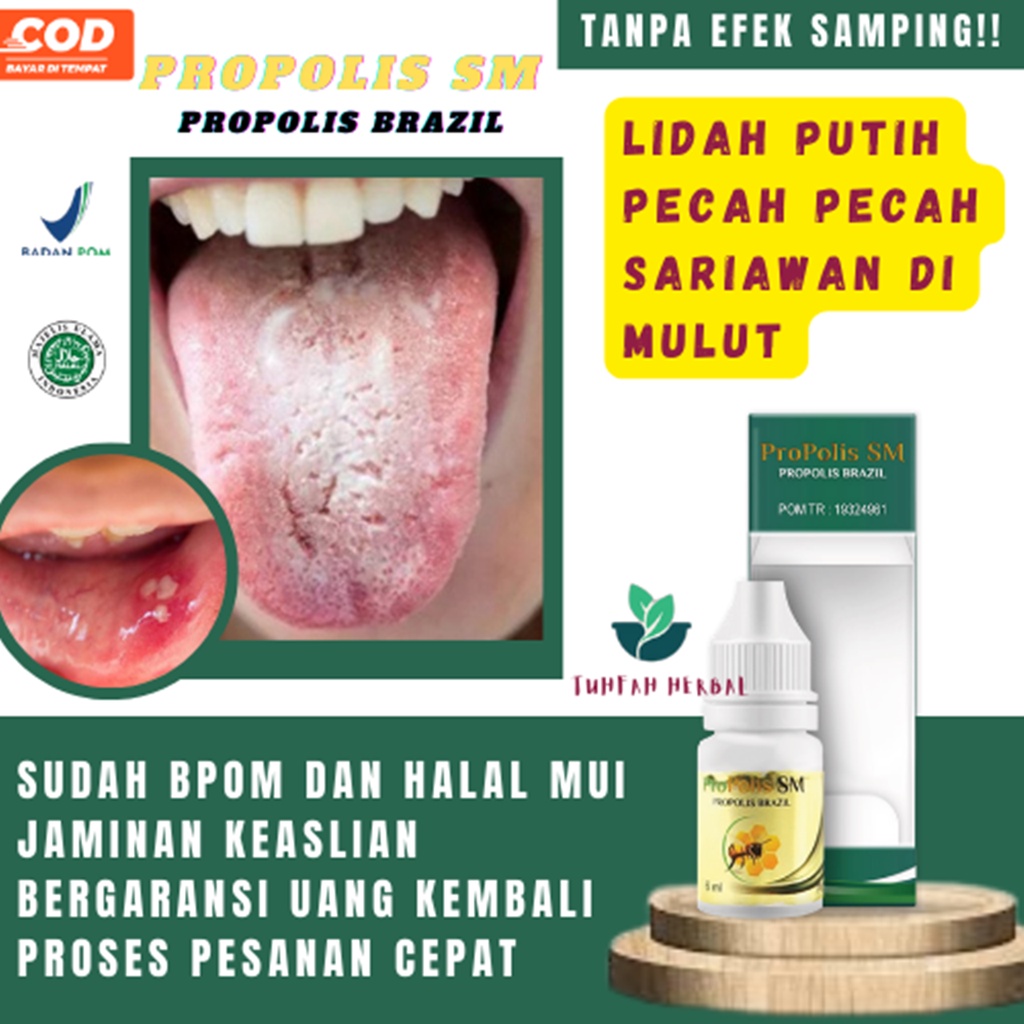 Jual Obat Lidah Putih Berjamur Pecah Pecah Luka Mati Rasa Panas Dalam