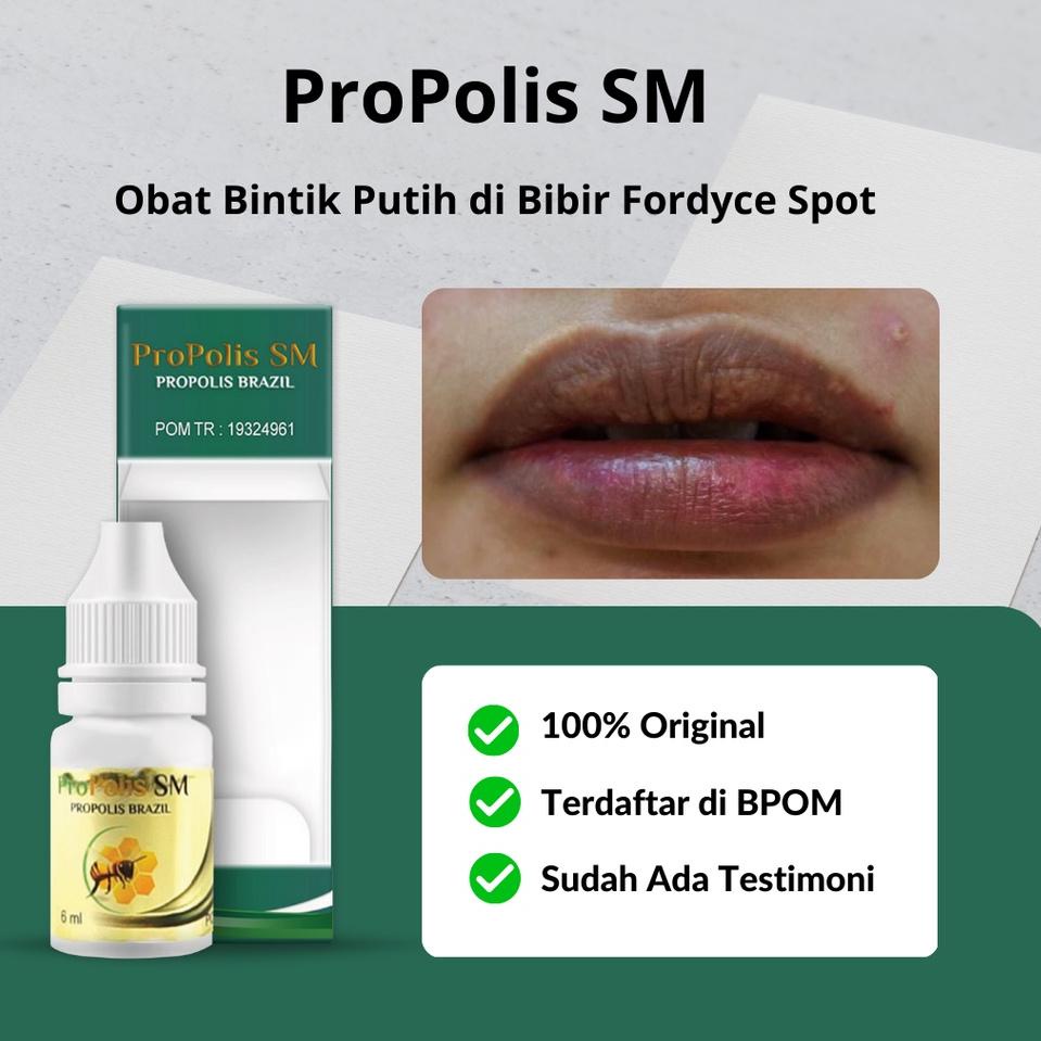 Jual Harga Spesial Propolis Sm Obat Bintik Putih Di Bibir Penghilang Bintik Putih Di Bibir