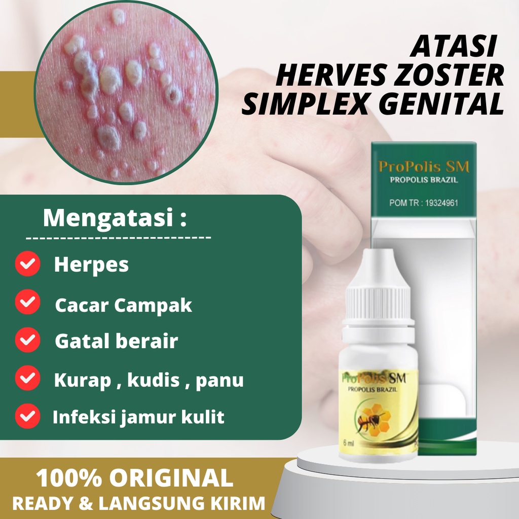 Salep herpes topikal untuk pengobatan infeksi virus herpes