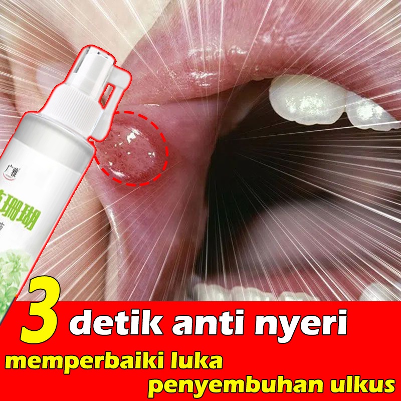 Jual Mouth Spray Mouth Ulcer Obat Sariawan 30ml Sore Throat Relief