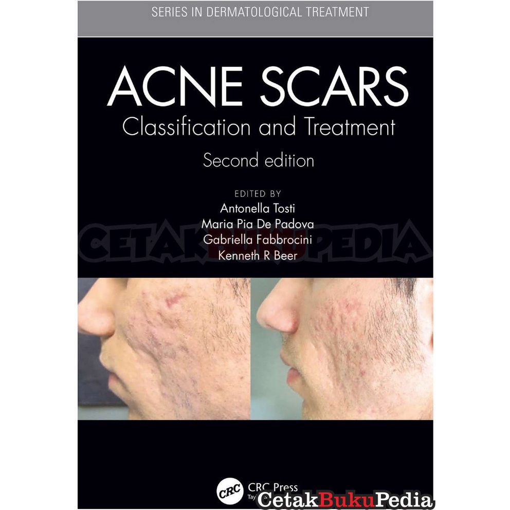 Jual Book Acne scars- classification treatment | Shopee Indonesia