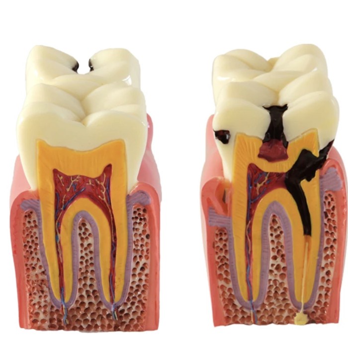 Jual MODEL GIGI ANATOMI KARIES | Shopee Indonesia