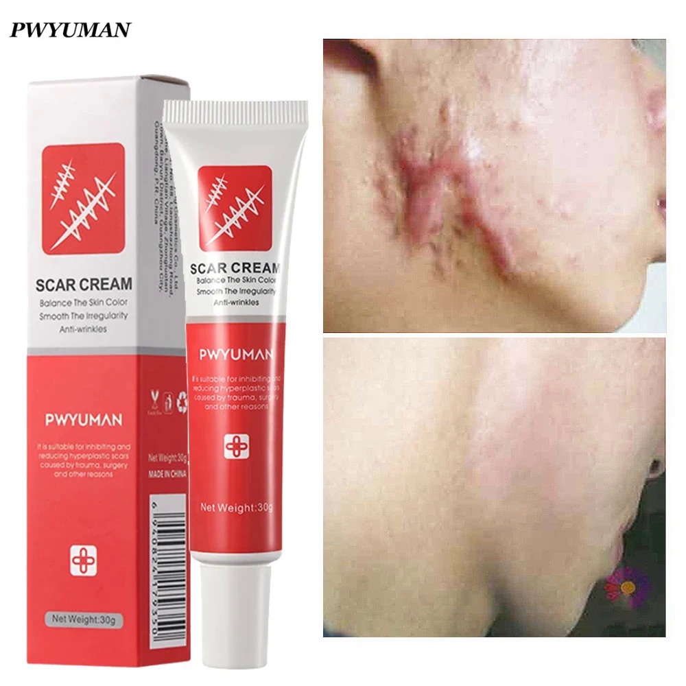 Jual Effective Scar Removal Cream Acne Scars Repair Gel Treatment
