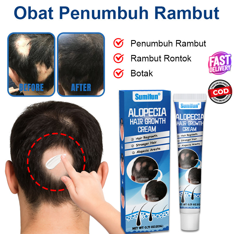 Jual 100% ORI Obat Penumbuh Rambut | Penumbuh Rambut Botak | Obat ...