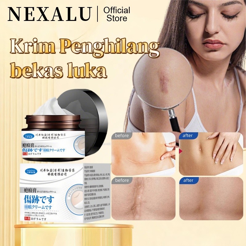 Jual NEXALU Krim Penghilang Bekas Luka Hitam Koreng di Wajah Obat ...