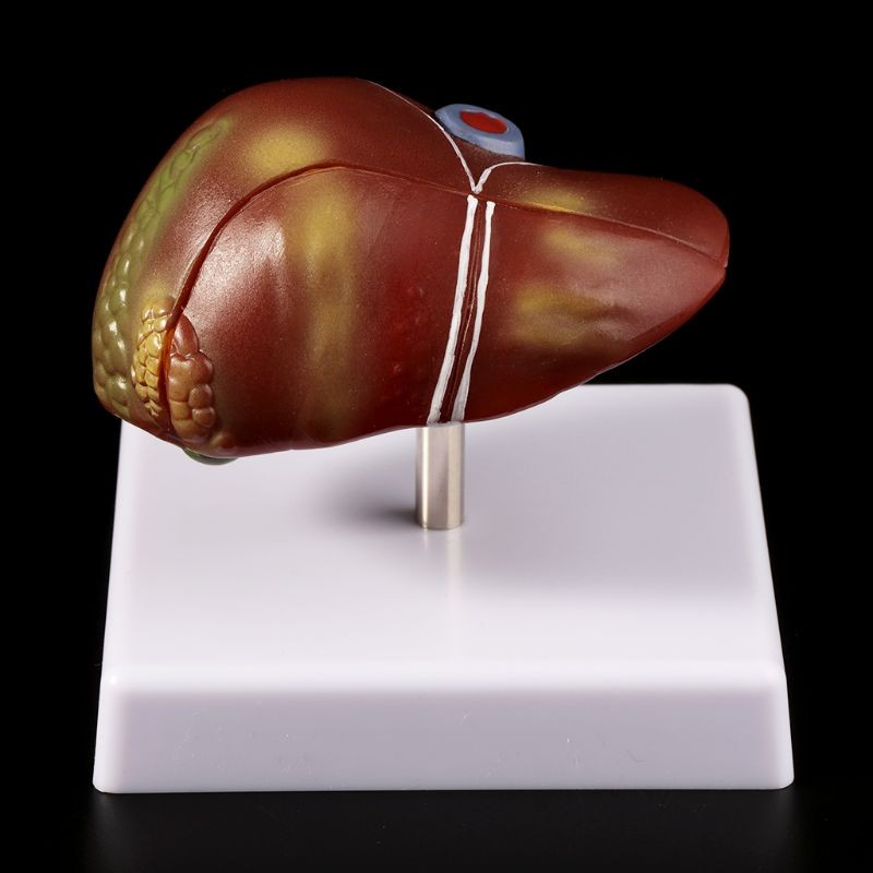 Jual GERAI SUKSES Medical props model Human Liver Pathological ...