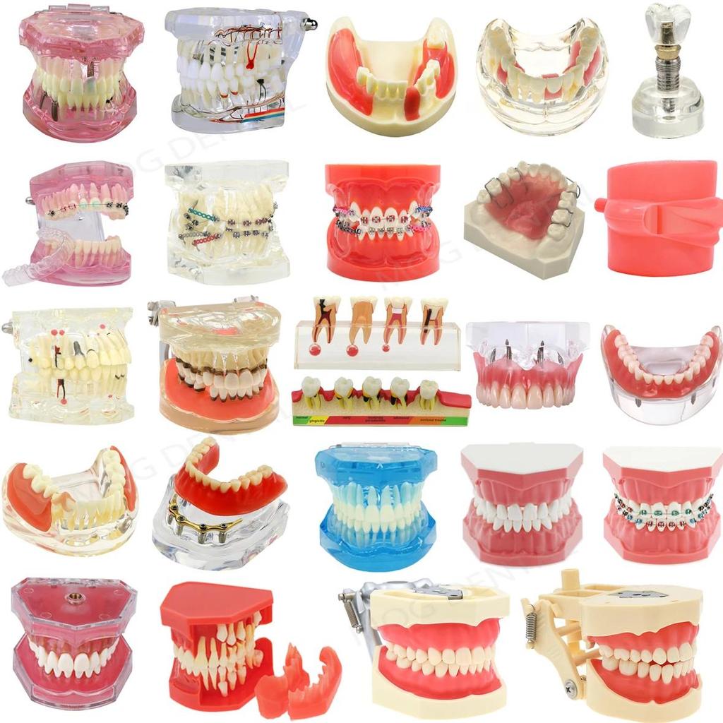 Jual Dental Teeth Model Implant with Removable Dental Education Model ...