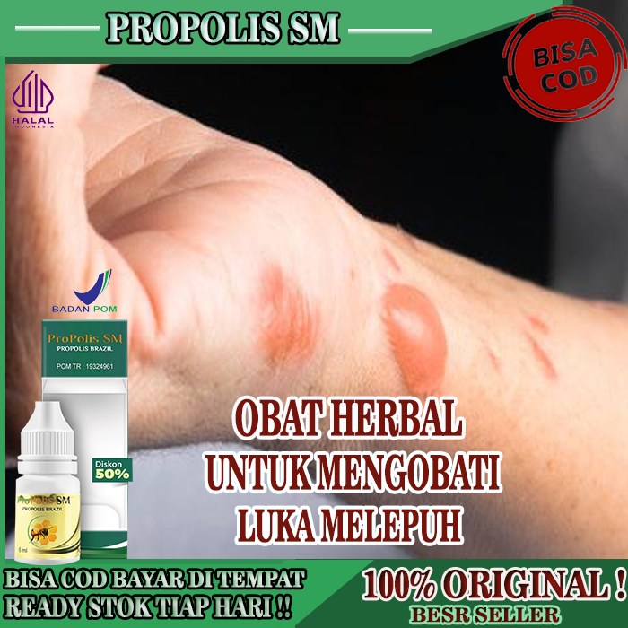 Jual Obat Luka Melepuh Obat Luka Bakar Air Panas Melepuh Obat Luka