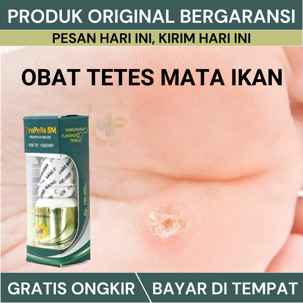 Jual Obat Tetes Mata Ikan Di Telapak Kaki Telapak Tangan Nyeri Mata Ikan Bengkak Bernanah