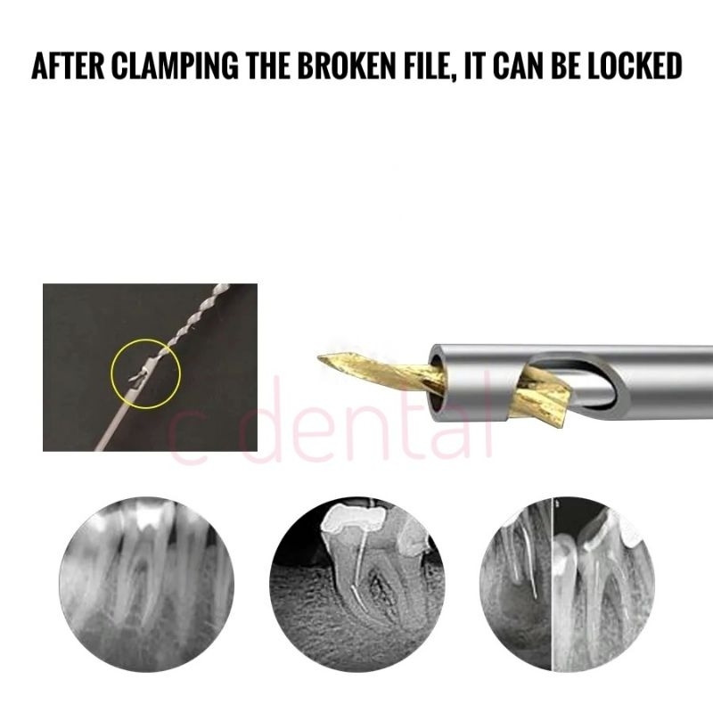 Jual Dental Endo Remover Broken File Root Canal Set Shopee Indonesia