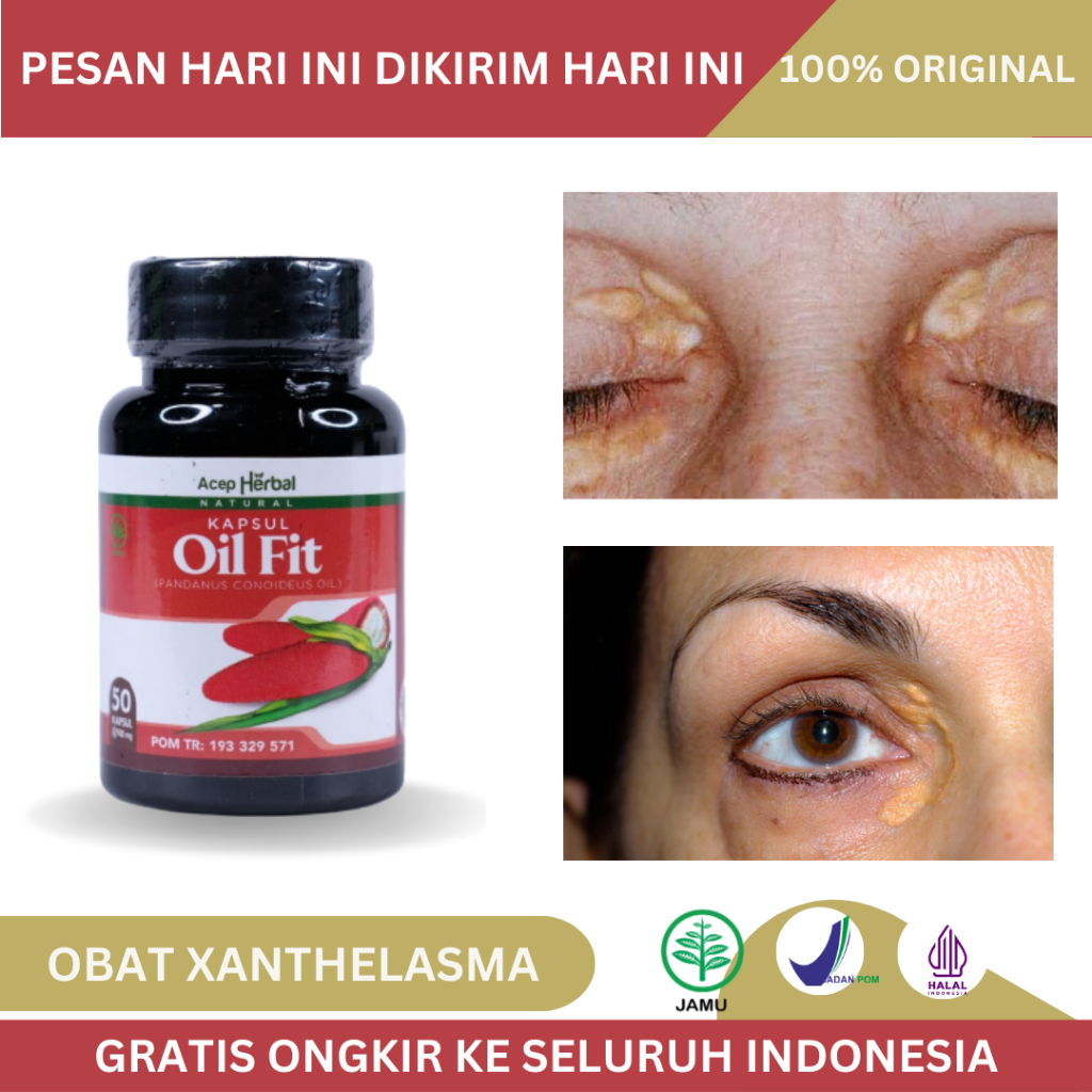 Jual Obat Xanthelasma, Gumpalan Lemak Santelasma Di Kelopak Mata ...