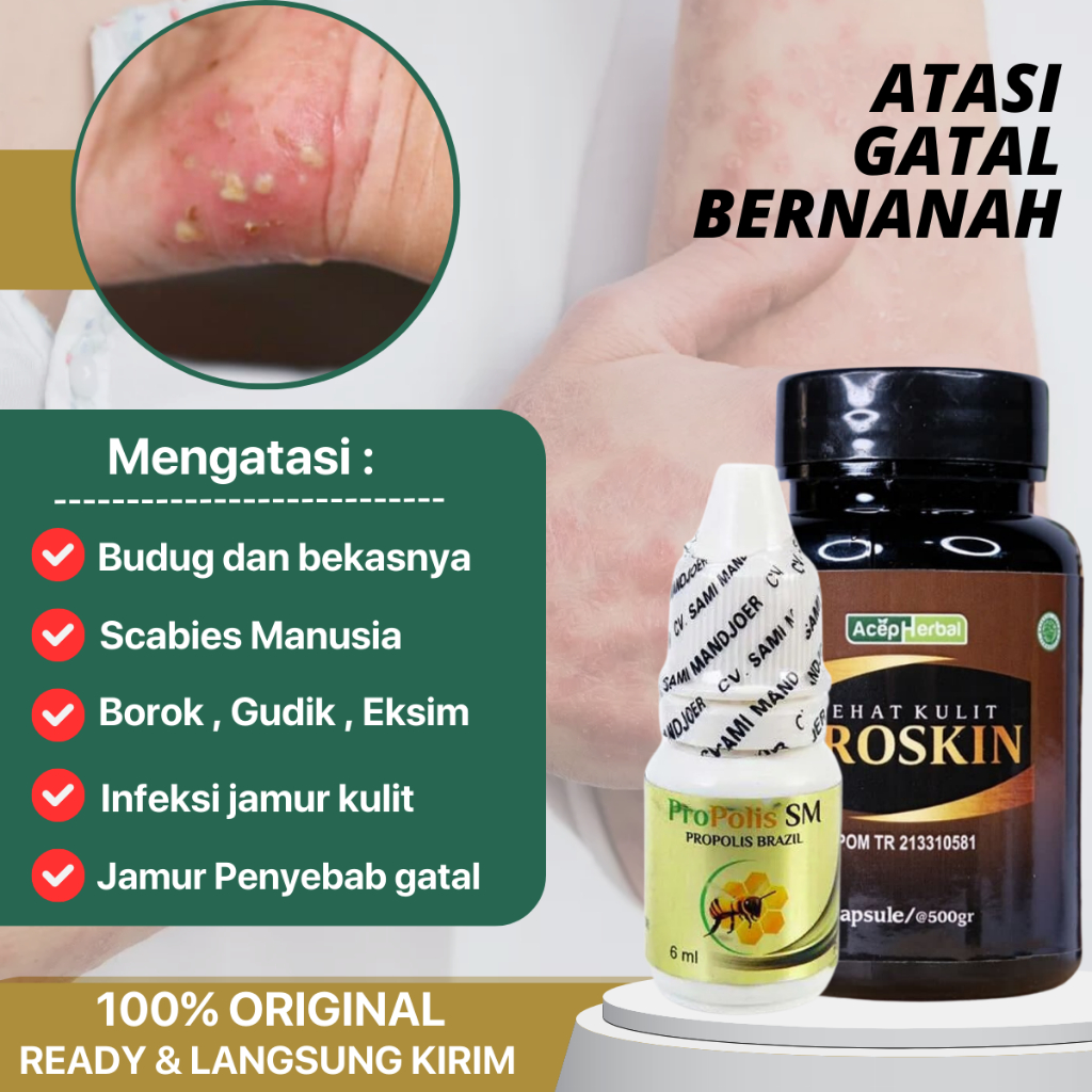 Jual Proskin Obat Gatal Berair Gatal Bernanah Gatal Bintik Bintik Merah Gatal Kulit Alergi