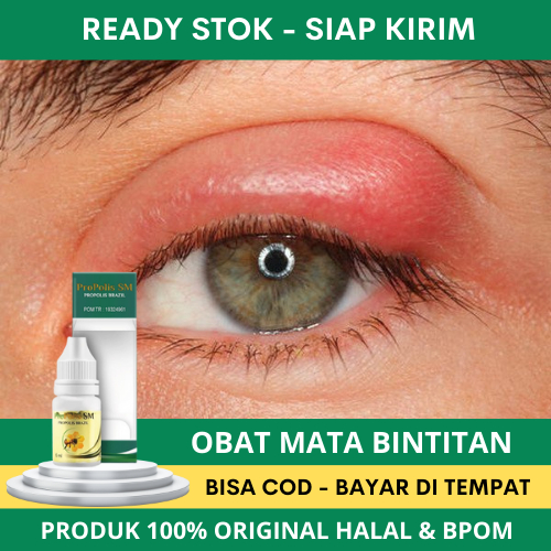 Jual Obat Bintitan, Obat Mata Bintitan Anak Dan Dewasa, Bintitan di ...