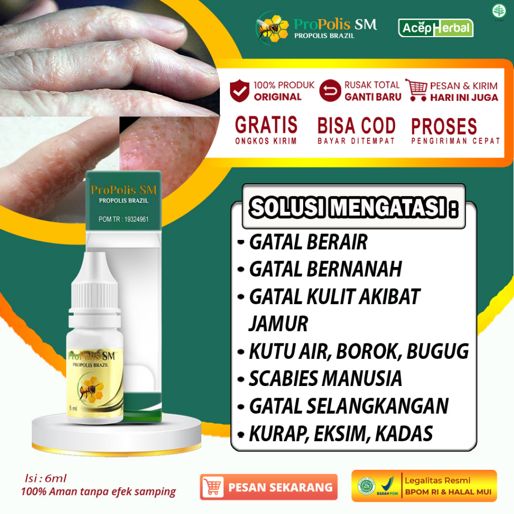 Jual Obat Gatal Berair Di Jari Tangan Dan Kaki Kutu Air Bintik Bintik Salep Cacar Air Penghilang