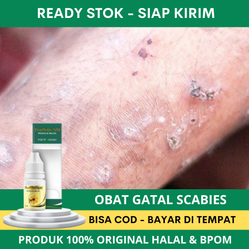 Jual Obat Gatal Scabies Obat Gatal Scabies Manusia Obat Scabies Untuk