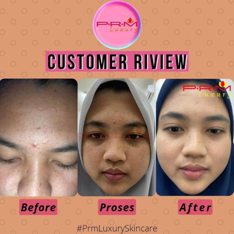 Jual Skincare Prm Luxury Glow Acne Flek Aman Bumil Busui Bpom Free