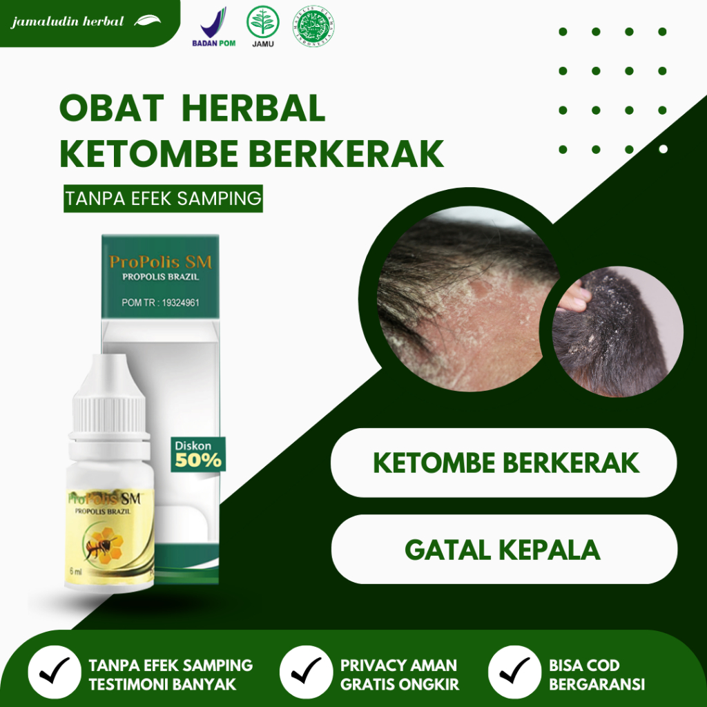 Jual Obat Kerak Ketombe Obat Ketombe Propolis SM ASLI Obat